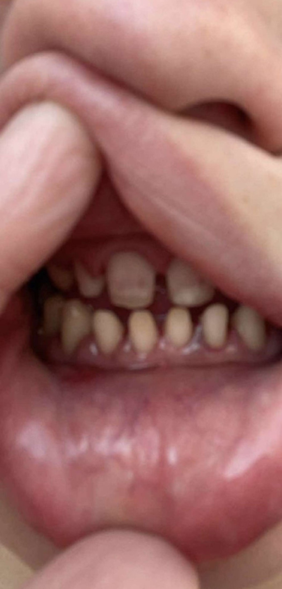 Put do katastrofe: Potpuno sam ostala bez zuba nakon puta u Tursku! (FOTO)