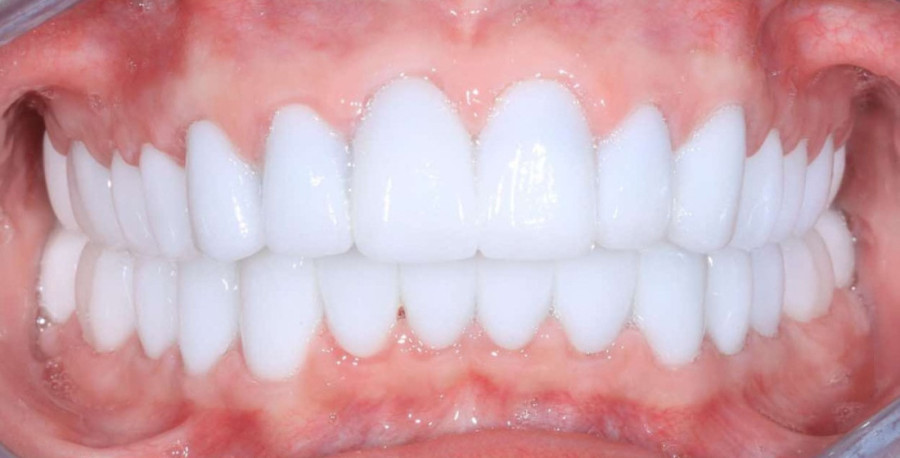 Dođu zbog lepote, vrate se bez organa i sa jezivim komplikacijama: Žena ima tragične posledice posle rutinske operacije u Turskoj (FOTO)