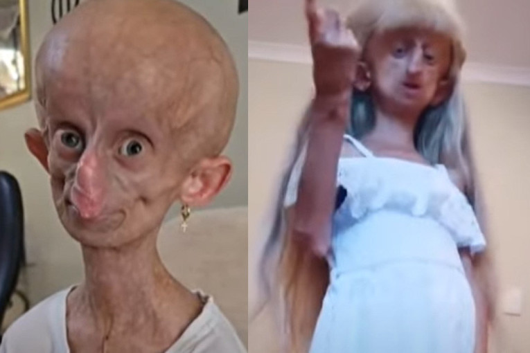 Godišnje je starila osam godina: Tiktok zvezda sa retkim zdravstvenim stanjem umrla u 19. godini (VIDEO)