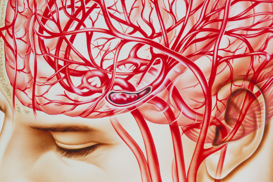 Šta se dogodilo ministru Glišiću? Simptomi moždanog udara i kako reagovati na vreme (VIDEO)