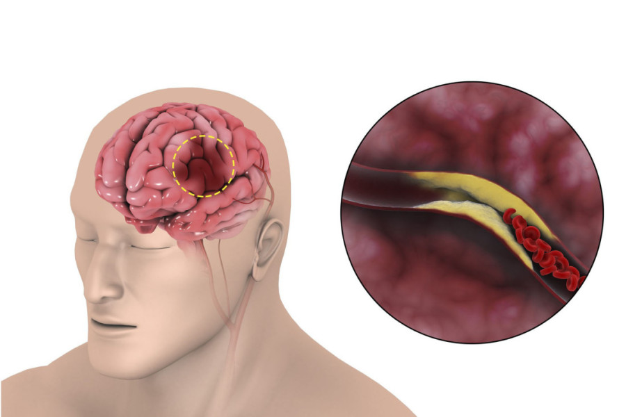 Muškarac preživeo moždani udar nakon što je primetio samo jedan, inače neobičan simptom