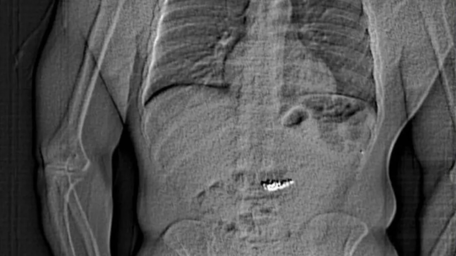 Lopov ih progutao, policija čekala: Posle dve nedelje izvučene dijamantske minđuše