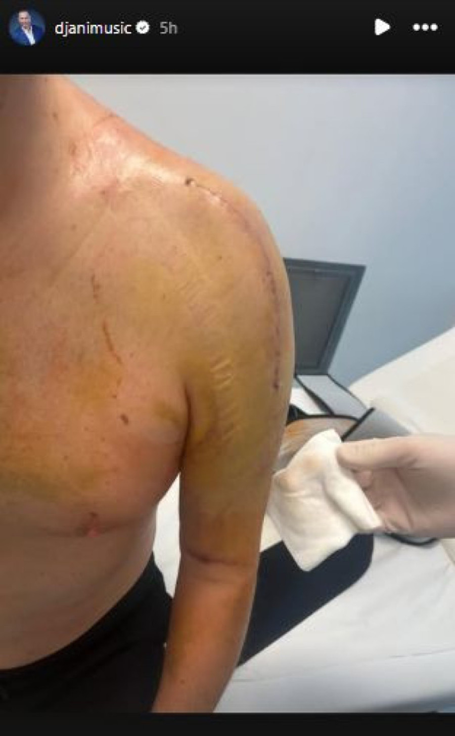 Đani pokazao ožiljke! Ovako folkeru izgleda ruka posle operacije (FOTO)