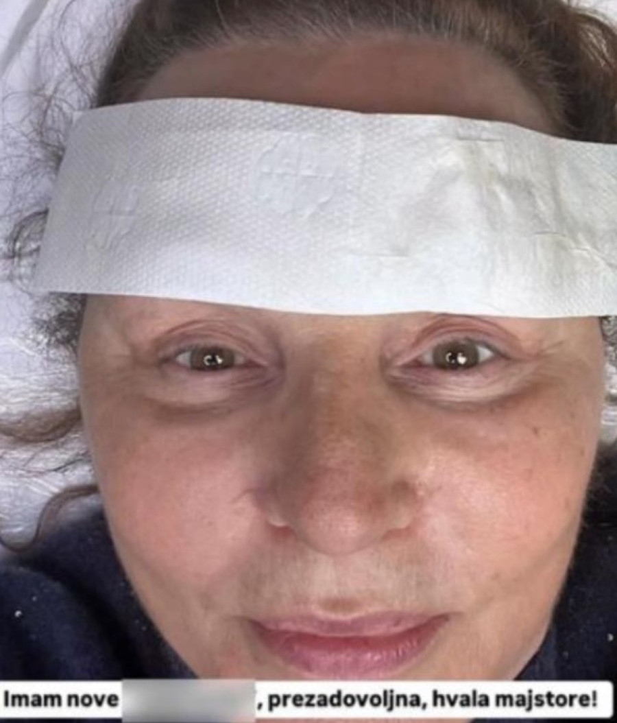 Pravo lice Ane Bekute bez šminke i filtera: Ne krije da je imala estetske korekcije (FOTO)