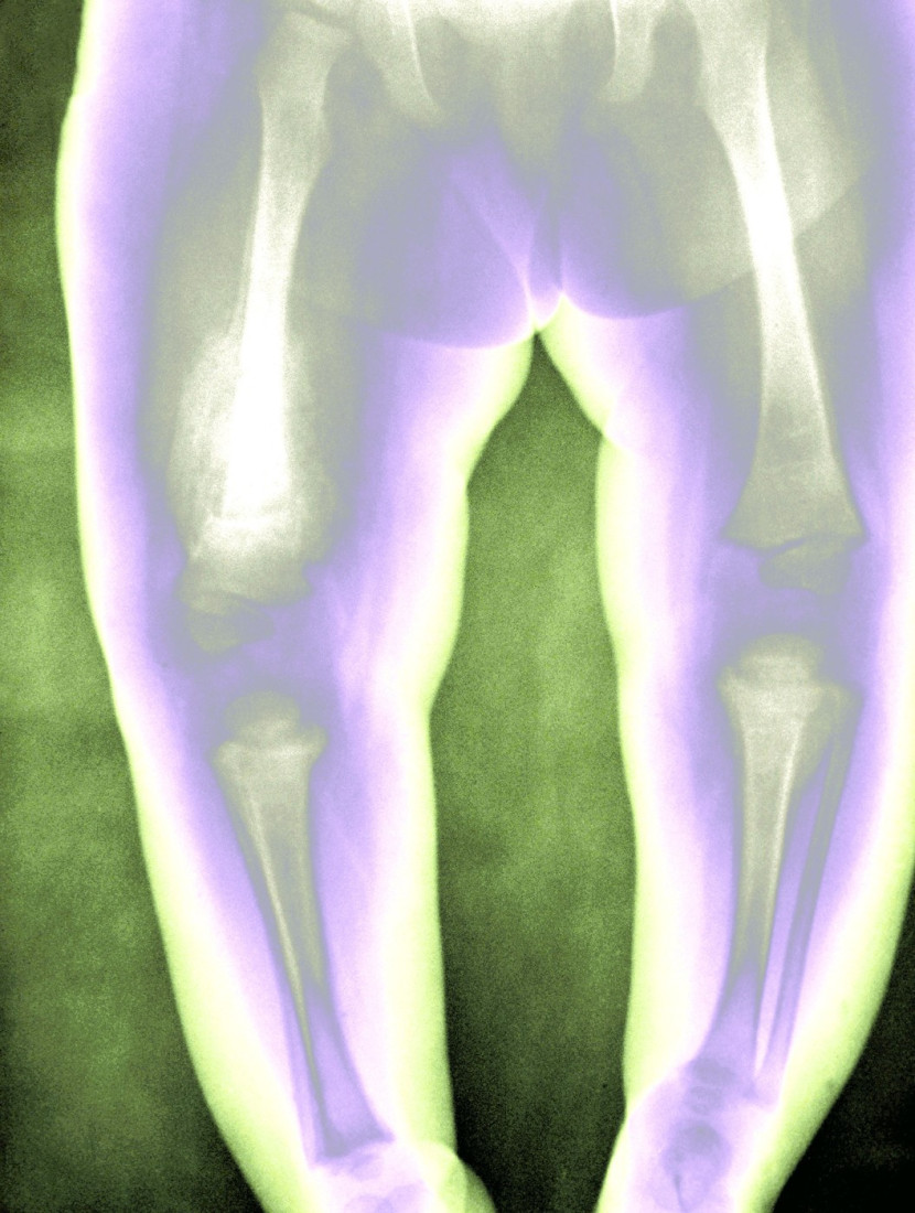 Marija ima kosti od stakla: Lomili su me 10 puta, a onda šok jer i moja devojčica ima istu bolest (FOTO)