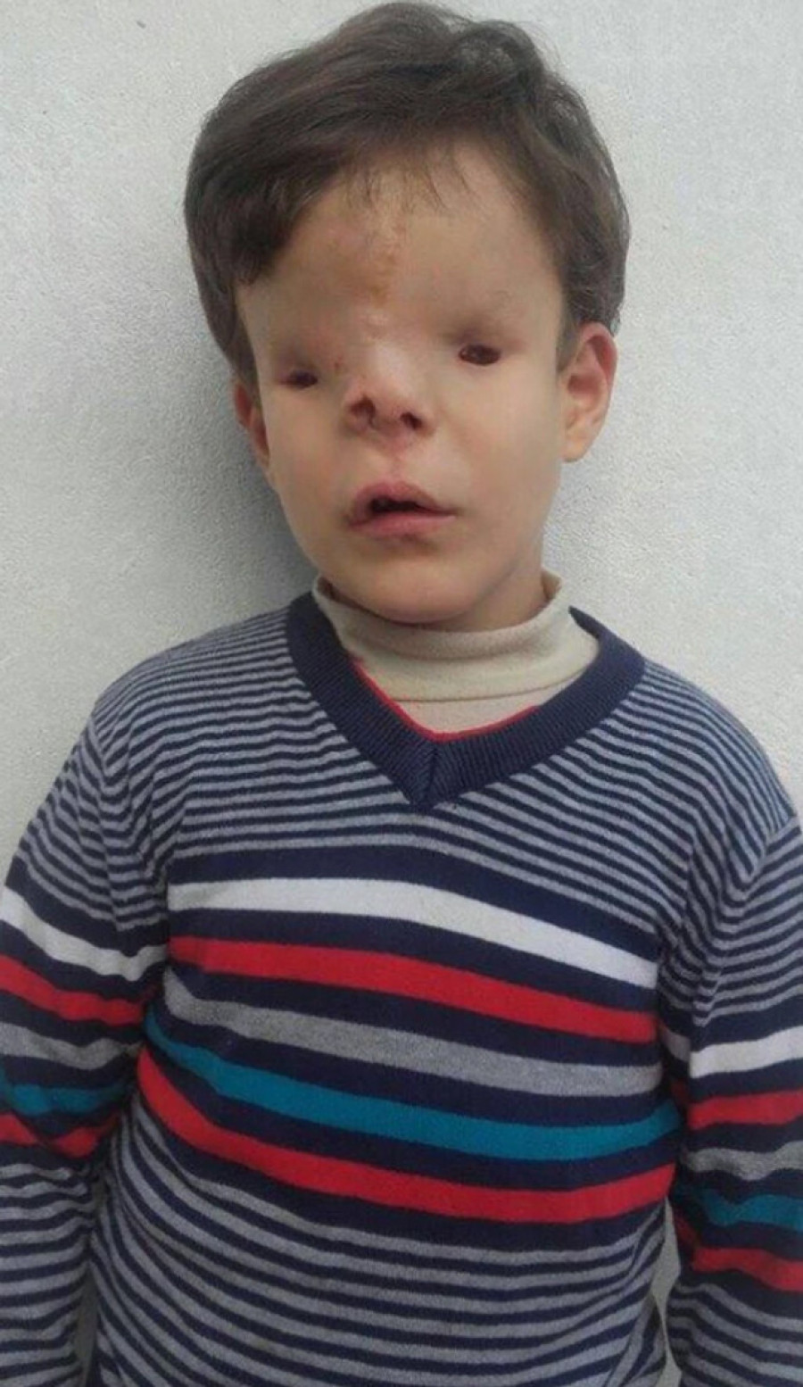 Neverovatna priča dečaka koji je rođen bez očiju, nosa i vilice: Plakali su kad se rodio, a danas svi plaču od sreće! (UZNEMIRUJUĆ SADRŽAJ)