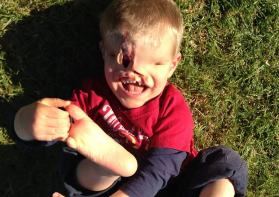 Neverovatna priča dečaka koji je rođen bez očiju, nosa i vilice: Plakali su kad se rodio, a danas svi plaču od sreće! (UZNEMIRUJUĆ SADRŽAJ)