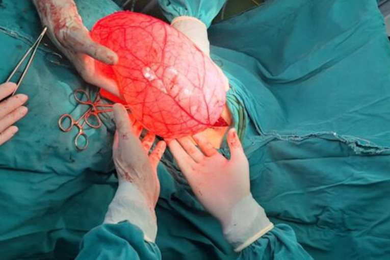 Valjevski hirurzi izveli čudo: Devojčici (15) izvađen tumor od 4 kilograma, a mislila da samo ne može da smrša