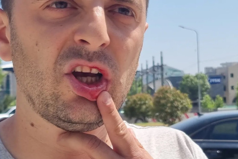 "Pokušao da me zgazi kolima, pa fizički nasrnuo na mene": Veljković brutalno napadnut u Kosovskoj Mitrovici (VIDEO)