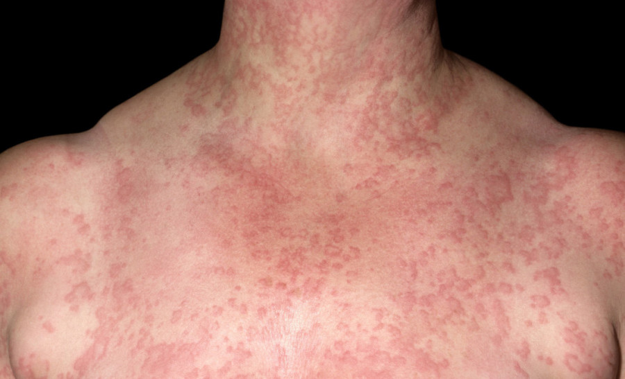 Lekari u panici: Ubod parazita izazvao alergiju na crveno meso