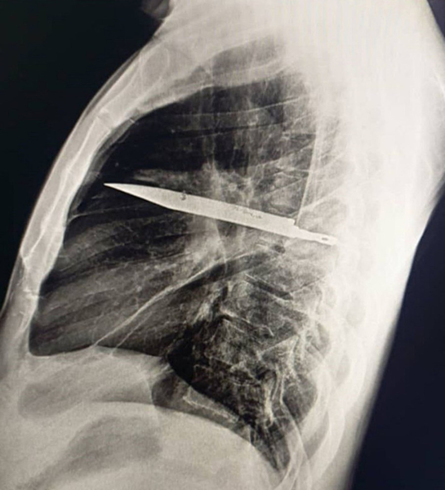 Čovek otišao kod lekara zbog gnoja iz bradavice: Rendgen otkrio užas koji je nosio u grudima osam godina! (FOTO)
