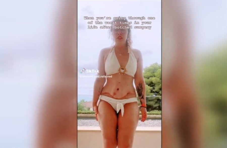 Dođu zbog lepote, vrate se bez organa i sa jezivim komplikacijama: Žena ima tragične posledice posle rutinske operacije u Turskoj (FOTO)