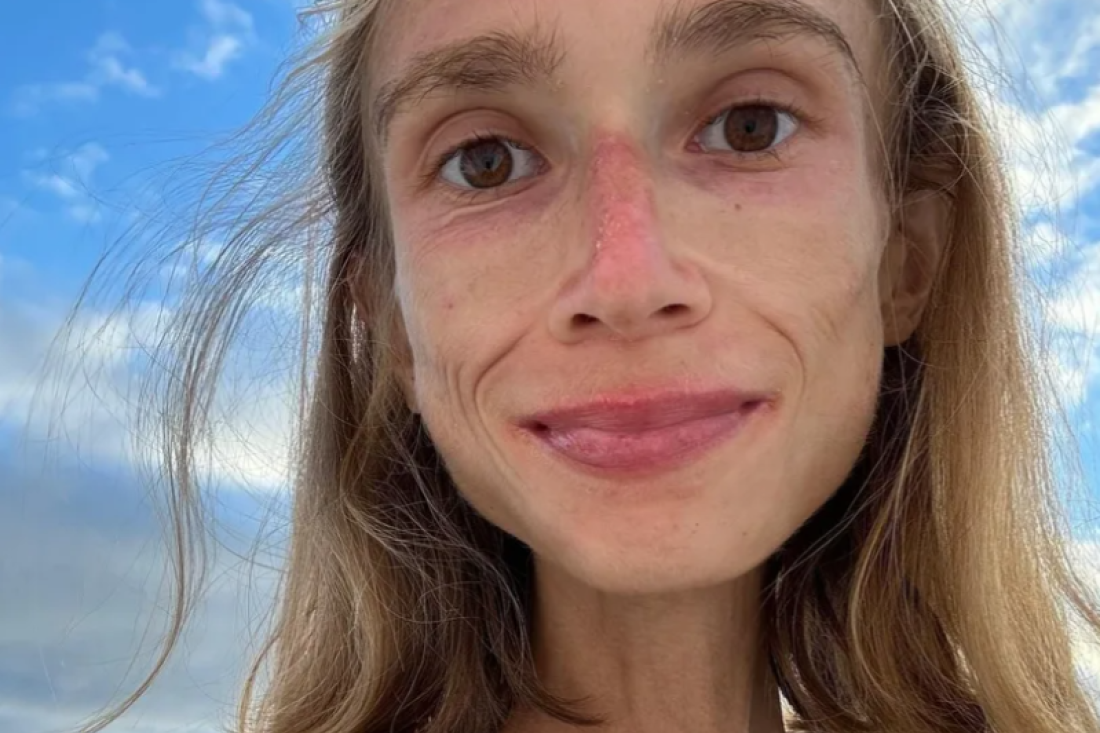 Voće joj došlo glave: Karolina zbog ekstremne dijete spala na 22 kilograma, umrla sama u hotelskoj sobi!