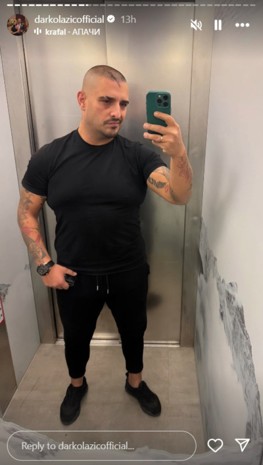 Evo kako Darko Lazić izgleda nakon saobraćajke: Skinuo zavoje, preko cele glave ožiljak! (FOTO)