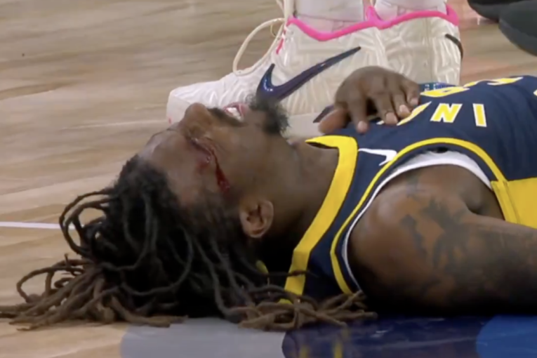Užasna scena u NBA! Košarkaš Indijane krvav ležao na parketu posle sudara glavama!