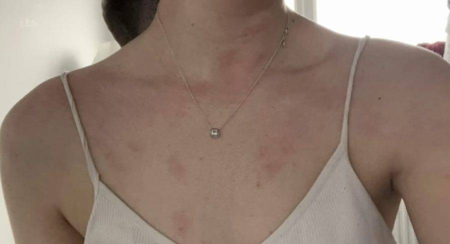 Devojka (24) alergična na vodu, pa joj tuširanje i znojenje izazivaju bol i osip: Svi su joj se podsmevali, mislili da drami (VIDEO)