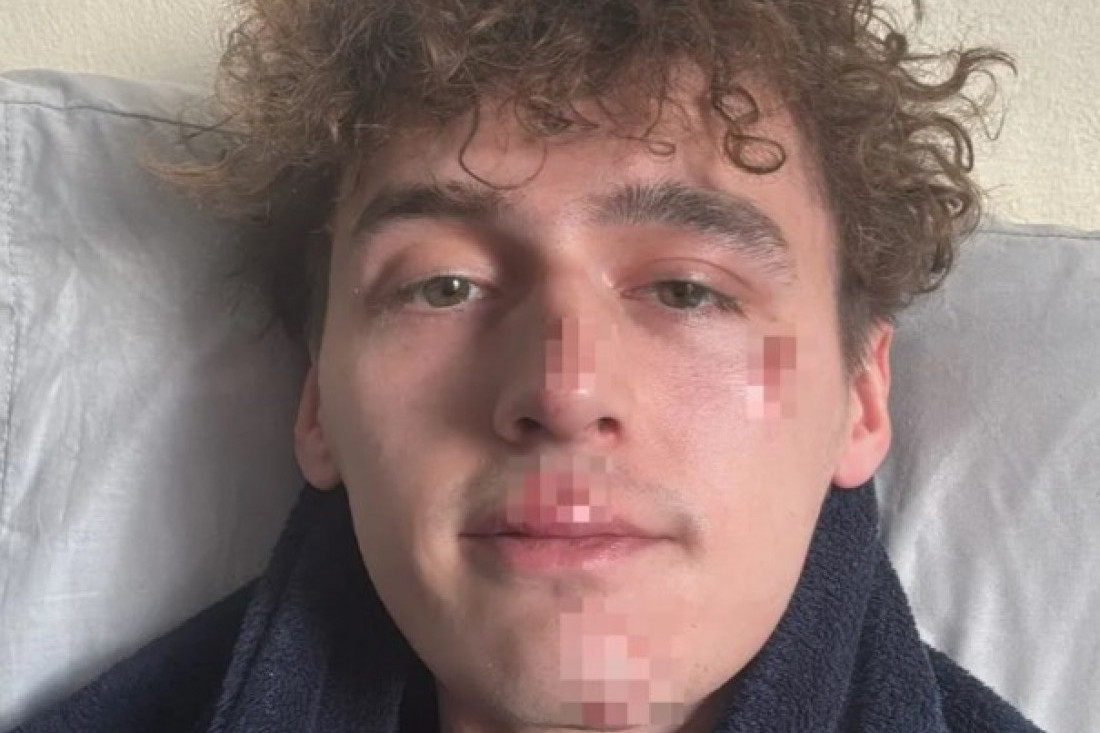 Pobednik "Velikog brata" pretučen: Sav je krvav i u podlivima (FOTO)