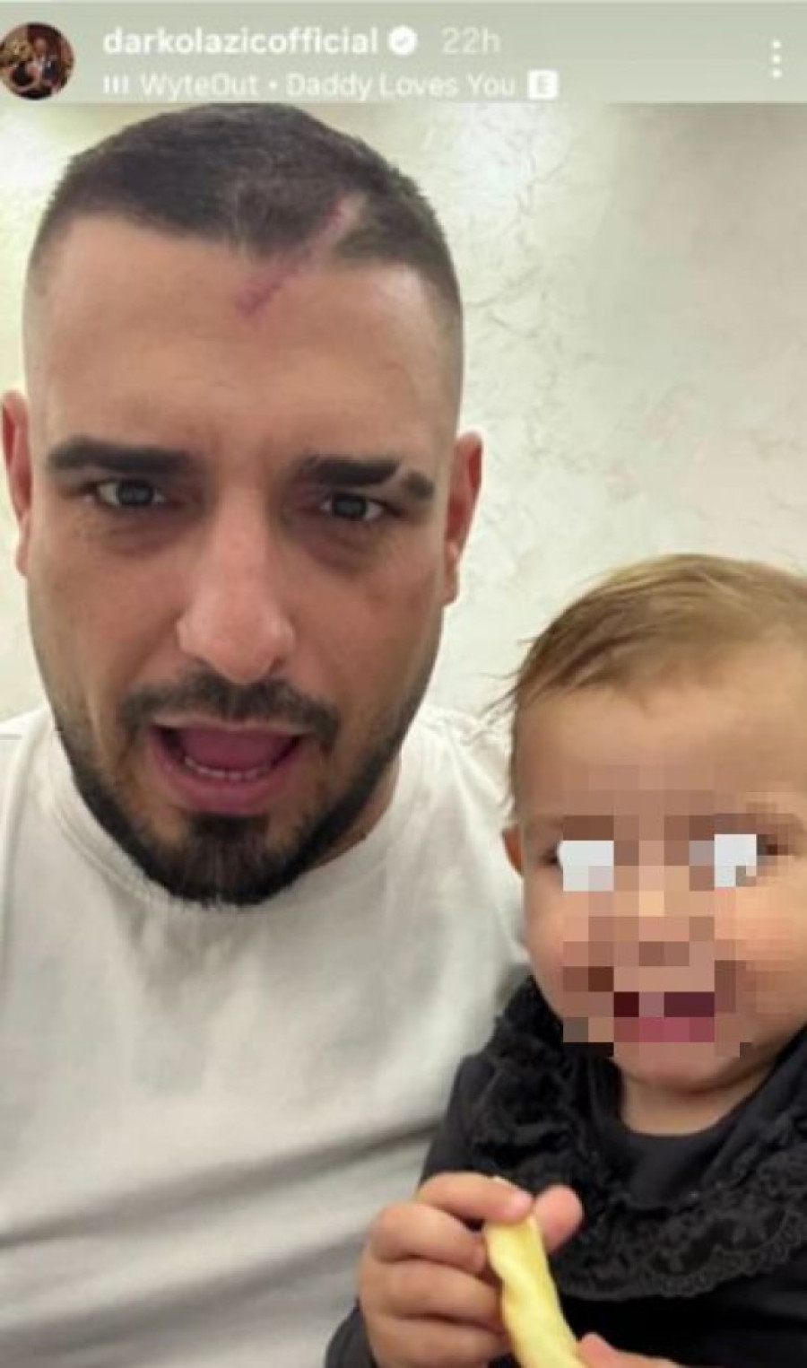 Veliki ožiljak i obrijana glava: Ovako Darko Lazić izgleda mesec dana nakon udesa (FOTO)