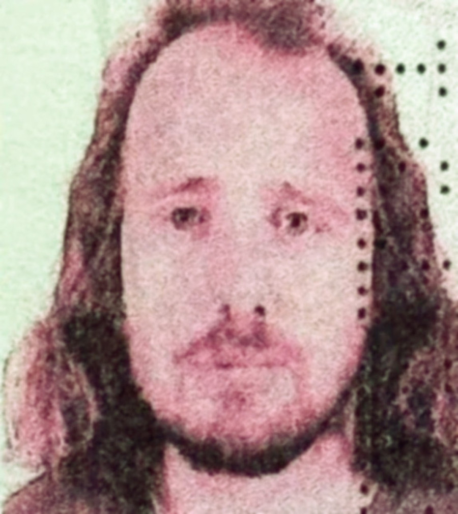 Tragičan kraj medicinskog turizma: Muškarac preminuo posle transplantacije kose u Turskoj