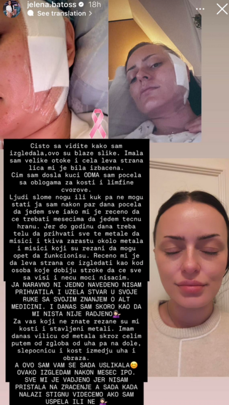 Bivša zadrugarka imala tešku operaciju nakon dijagnoze raka: "Rezali su mi kosti i stavljali... "