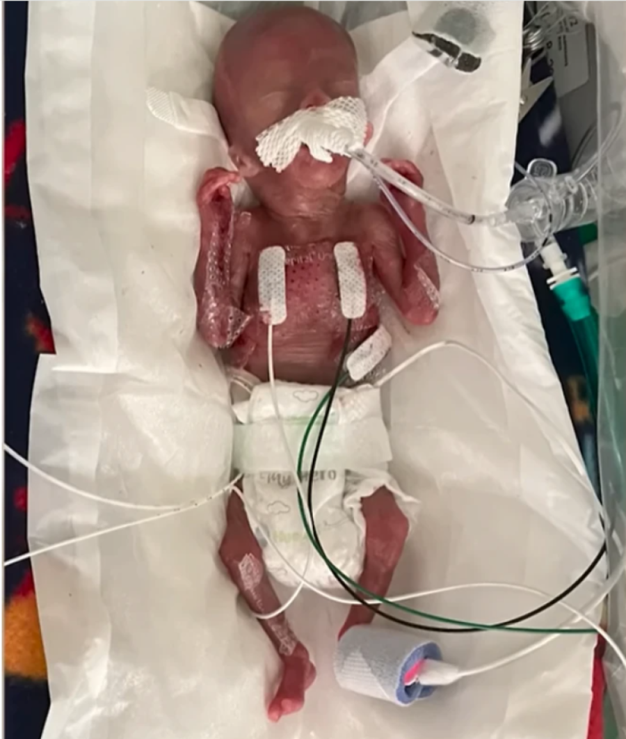 Kada se rodio, nije bio veći od očevog dlana i nije imao nikakve šanse da preživi: Rođen sa 283 grama,  danas ispisuje istoriju (FOTO)