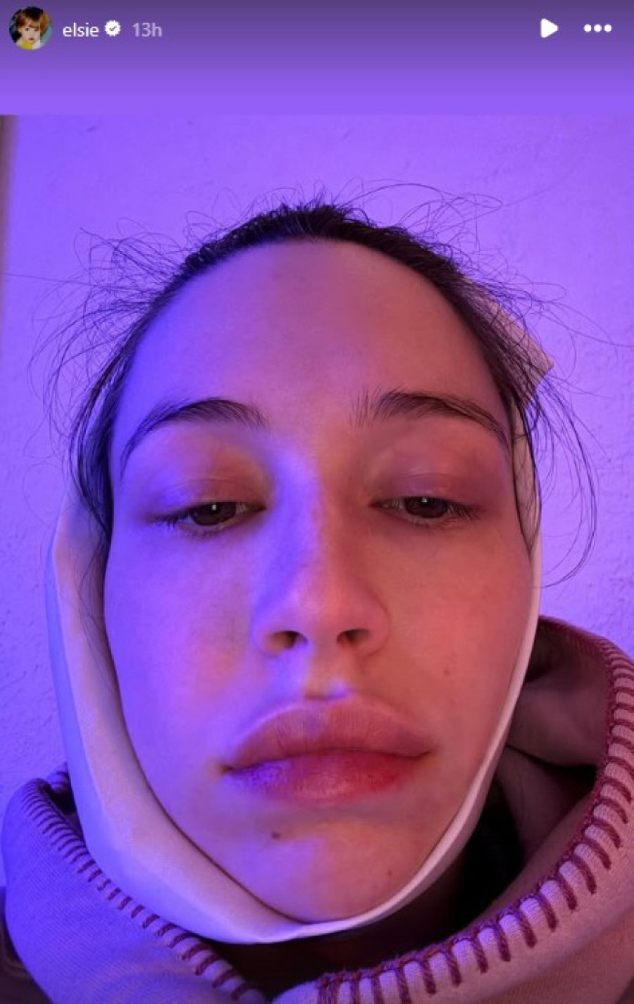 Odmah posle porođaja morala da povadi ove zube! Devojka Pita Dejvidsona pokazala kako sad izgleda (FOTO)