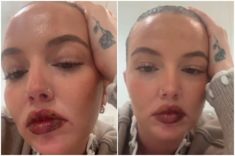 Ni u najgorim snovima nije mislila da će joj se ovo desiti: Umesto lepih usana dobila je nepodnošljive bolove i prošla kroz pakao (VIDEO)