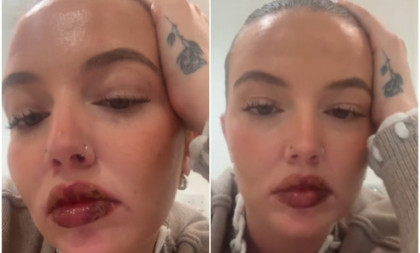 Ni u najgorim snovima nije mislila da će joj se ovo desiti: Umesto lepih usana dobila je nepodnošljive bolove i prošla kroz pakao (VIDEO)