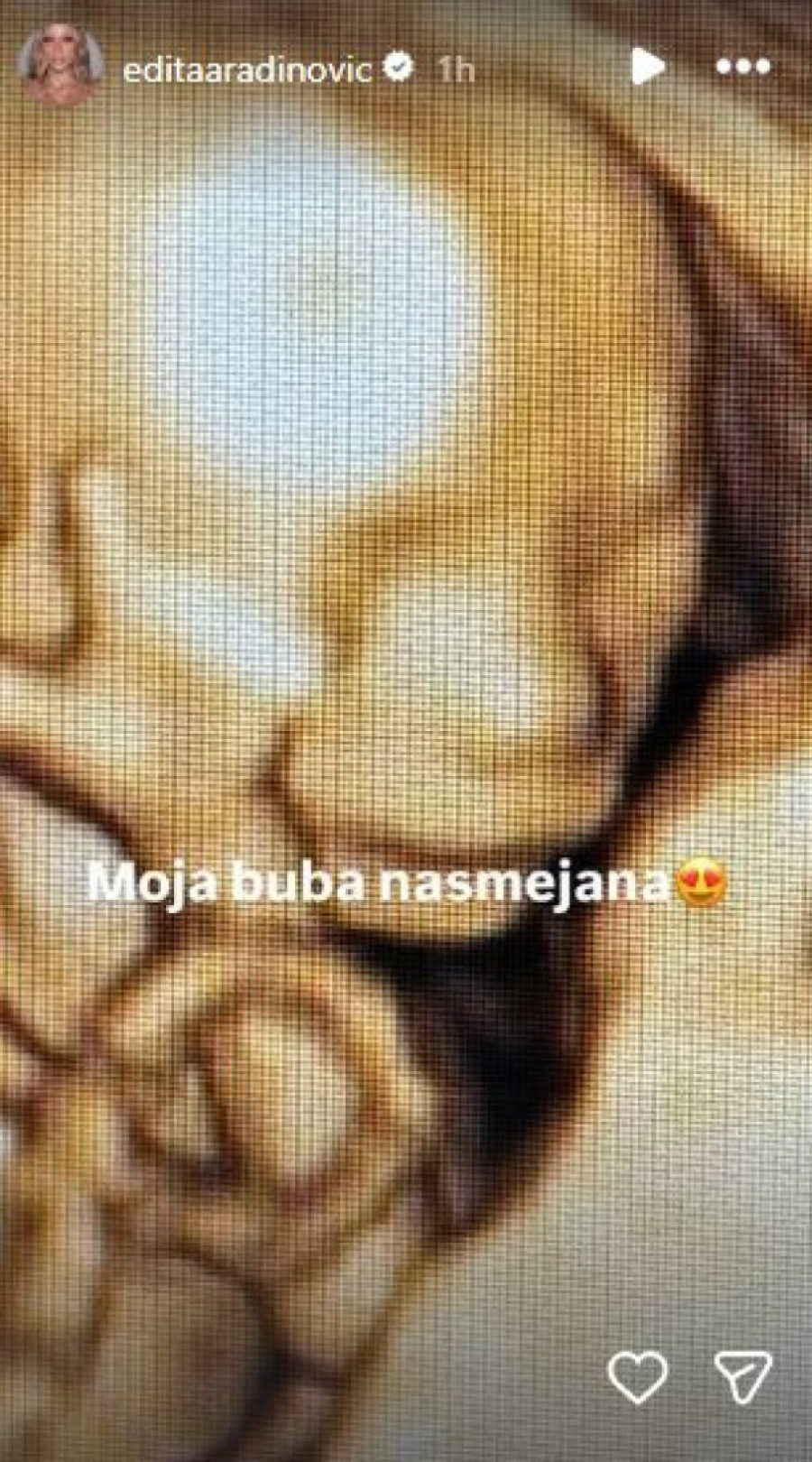 "Moja buba nasmejana!" Edita raspametila fotkom s ultrazvuka (FOTO)