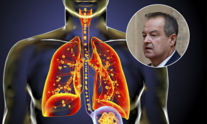 Ovo su simptomi obostrane upale pluća koju ima Ivica Dačić: Kada bolest zahvati oba plućna krila, disanje postaje borba za vazduh
