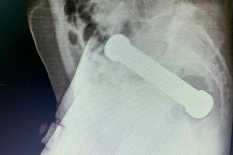 Muškarac iz Brazila se danima žalio na jake bolove, a doktori nisu mogli da veruju kada su saznali šta je razlog (FOTO)