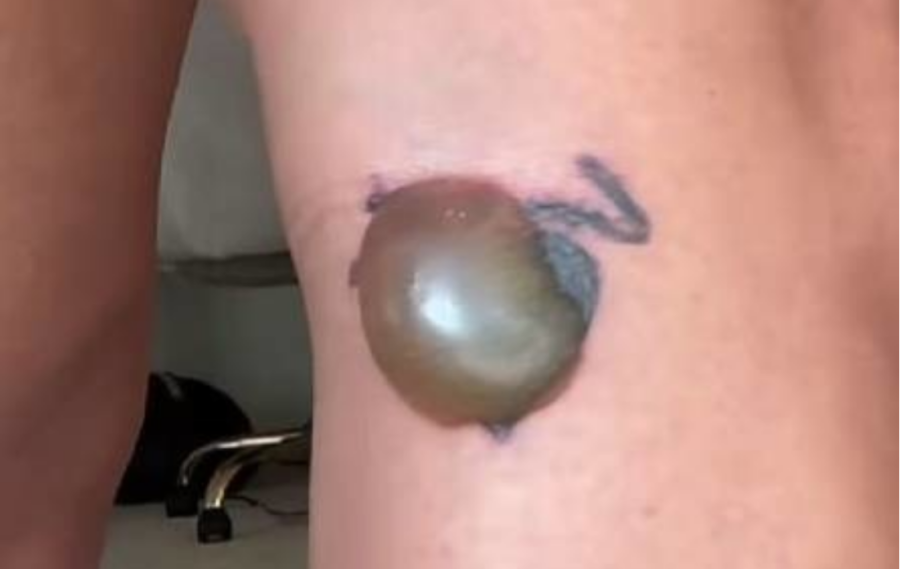 Influenserka u šoku posle uklanjanja tetovaže: Pokazala šta joj se pojavilo na nozi i užasno je (FOTO)