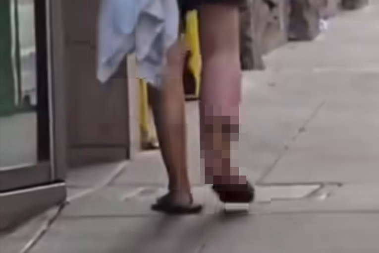 Uznemirujuće scene širom Amerike: Na ulicama se pojavili ljudi sa ranama na nogama i rukama, kod nekih se vide kosti (VIDEO)