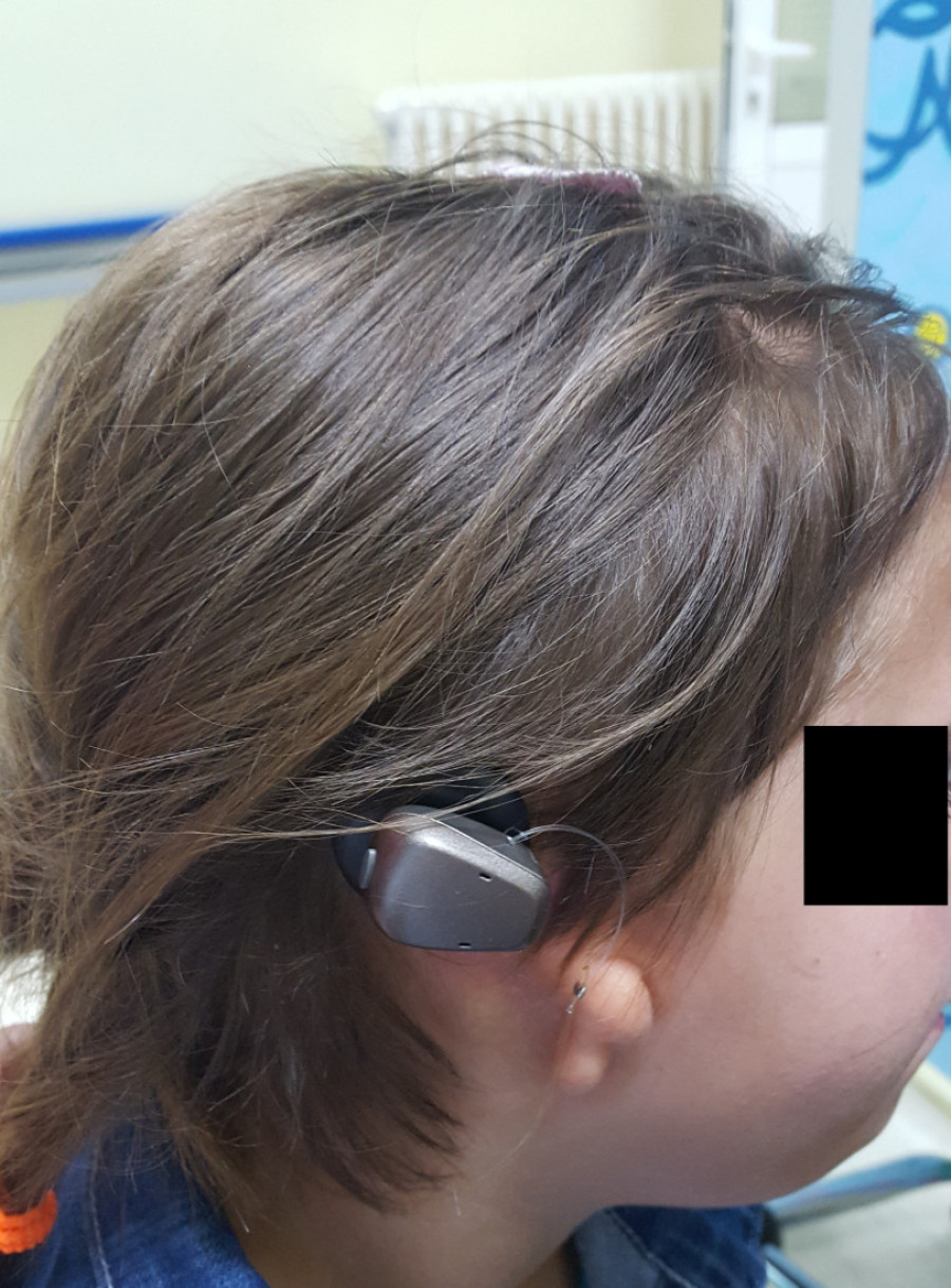 "Gluvoća će biti potpuno izlečiva!" Dr Baljošević otkriva kako će čipovi promeniti lečenje dece sa problemima sluha