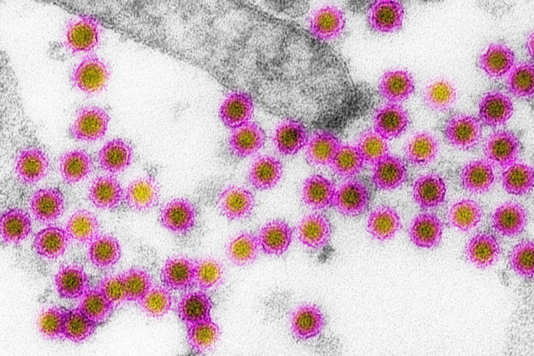 Opasni virus već potvrđen u Srbiji! Ove simptome nikako ne ignorišite, evo kako da se zaštitite od zaraze