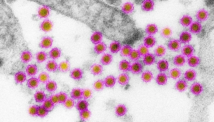 Opasan virus stigao u komšiluk! Potvrđeni novi slučajevi zaraze, evo koji simptomi pale alarm