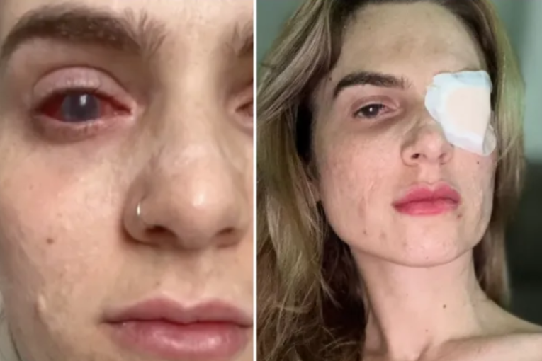 Zbog menstrualnih bolova popila ibuprofen, pa završila u komi: „Kao da sam izgorela iznutra“