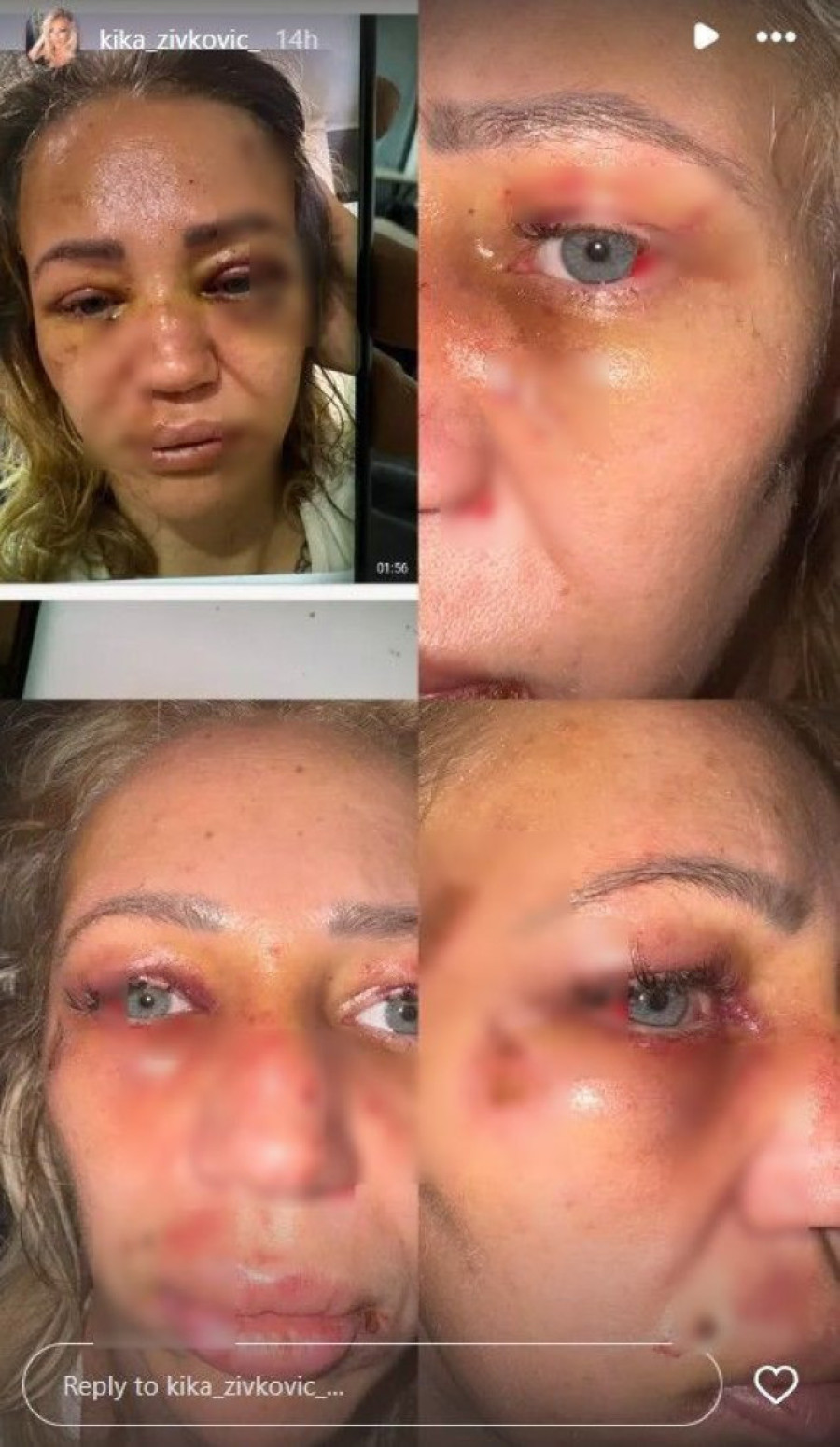 Oglasilo se tužilaštvo nakon zverski prebijene influenserke u Šapcu!
